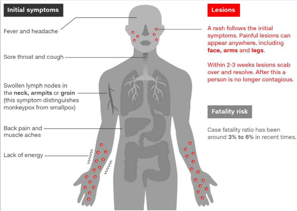 Summary of monkeypox symptoms according to the Annals of Medicine & Surgery of London