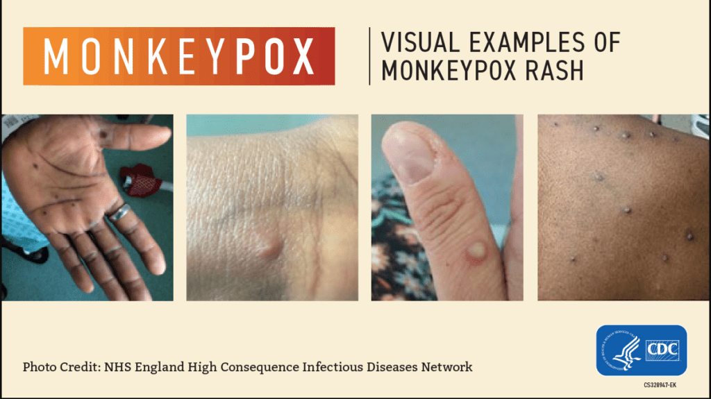 The CDC has provided pictures of examples of the monkeypox rash